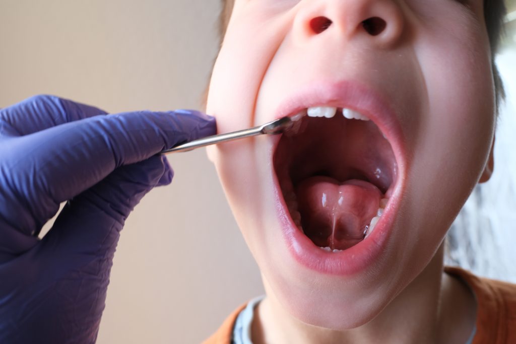 Tongue-Tie Issues in Kids